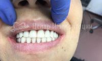 Восстановление зубов на двух челюстях  - Фотография 2